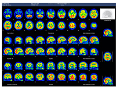 脳血流SPECT画像