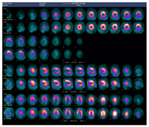 心筋血流SPECT画像